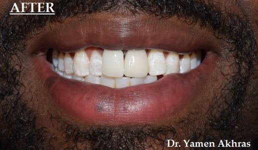 Dr. Akhras' patient's smile with lifelike implant crown